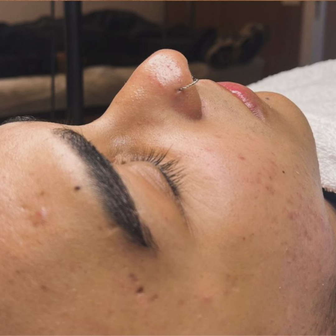 Protocolo Acne Control