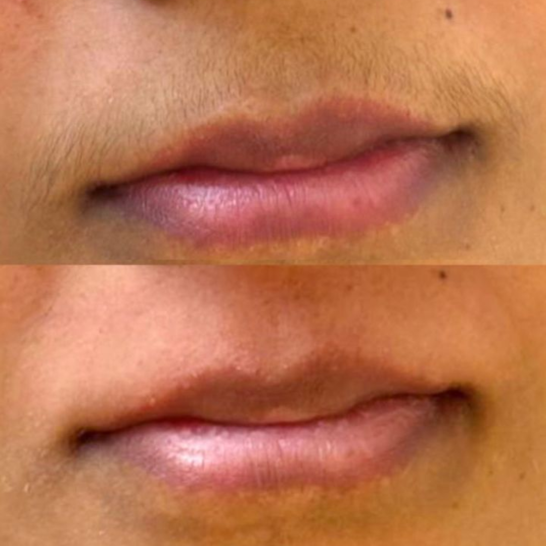 Depilação Facial
